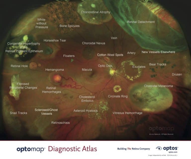 Optomap Retinal Imaging | Lifetime Eye Care